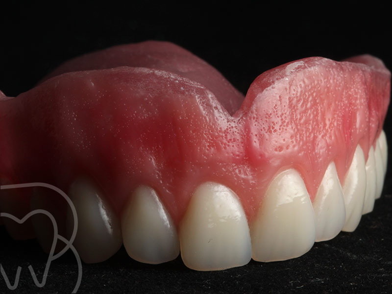 Clínica dental Bueno & Marquina. Prótesis completa removible