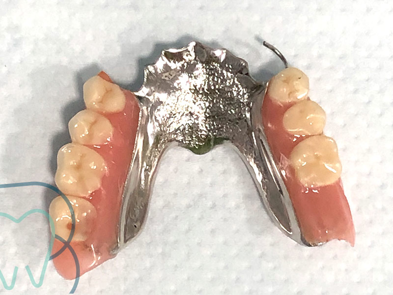 Clínica dental Bueno & Marquina. Prótesis parcial removible