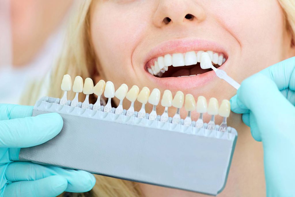 Cuánto dura blanqueamiento dental