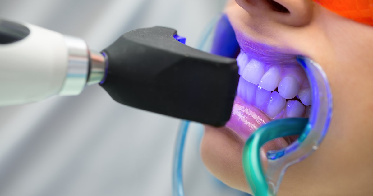 Cuánto dura un blanqueamiento dental