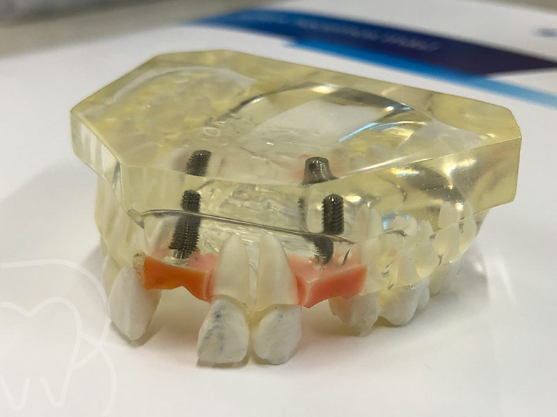 implante dental arganzuela y getafe