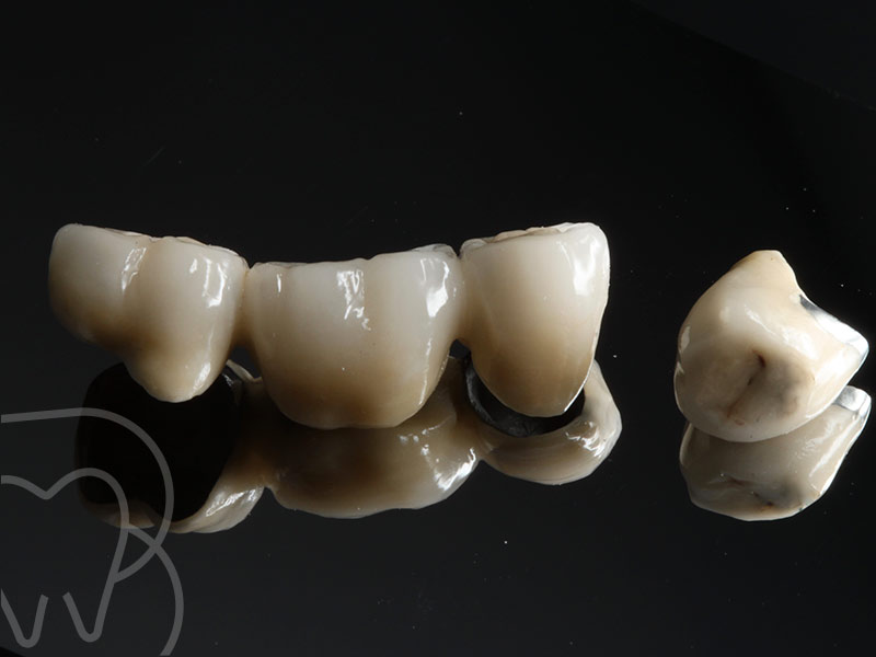 protesis dental arganzuela