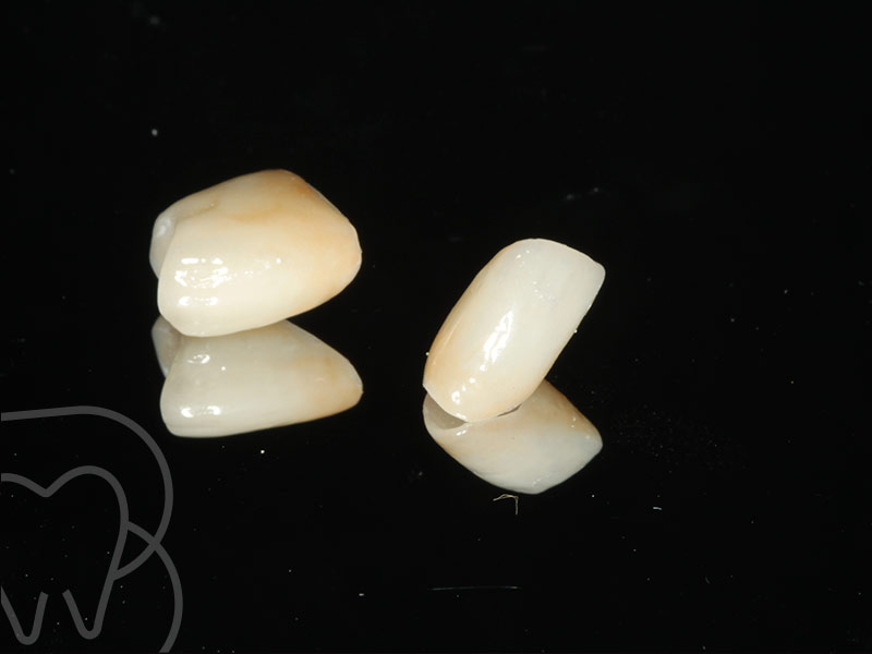 protesis dental en getafe