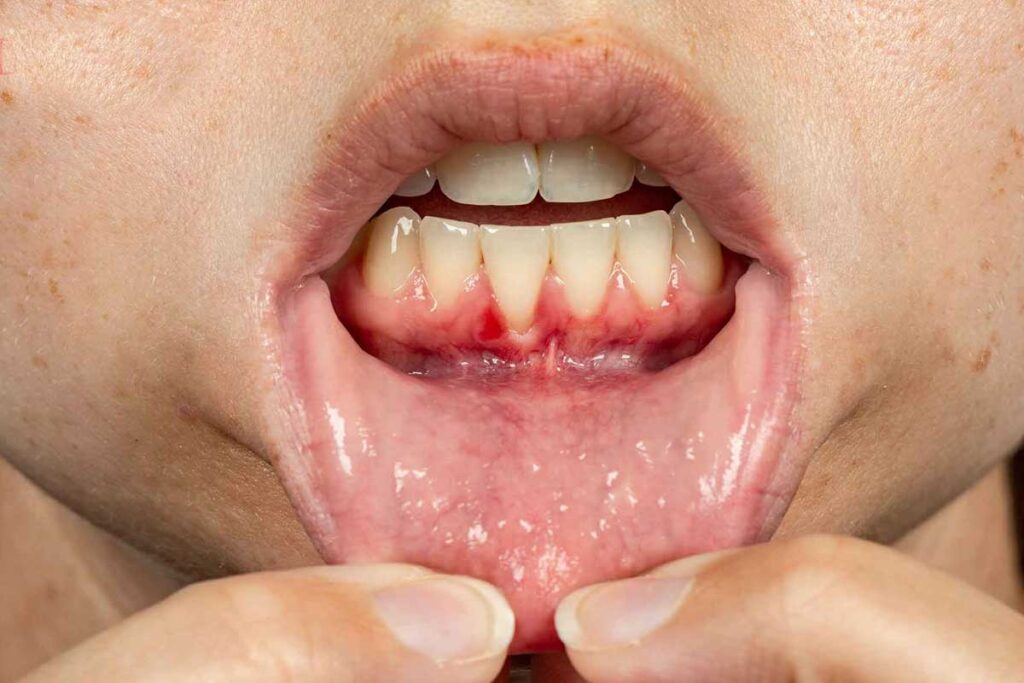 Periodontitis sintomas